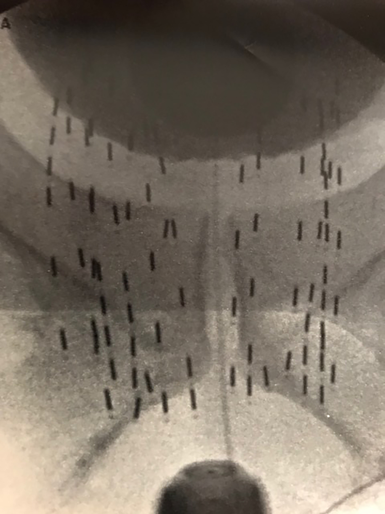 Extracapsular prostate brachytherapy using a cystogram showing extracapsular placement of seeds at the prostate/bladder junction.
