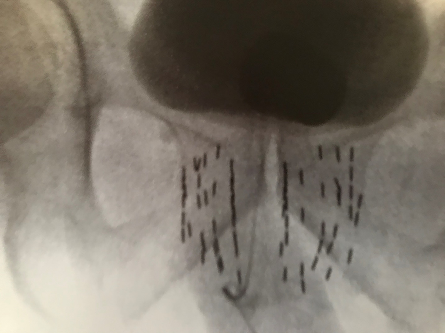 Prostate-only implant or standard prostate brachytherapy (SPB) using ultrasonography alone to place seeds.