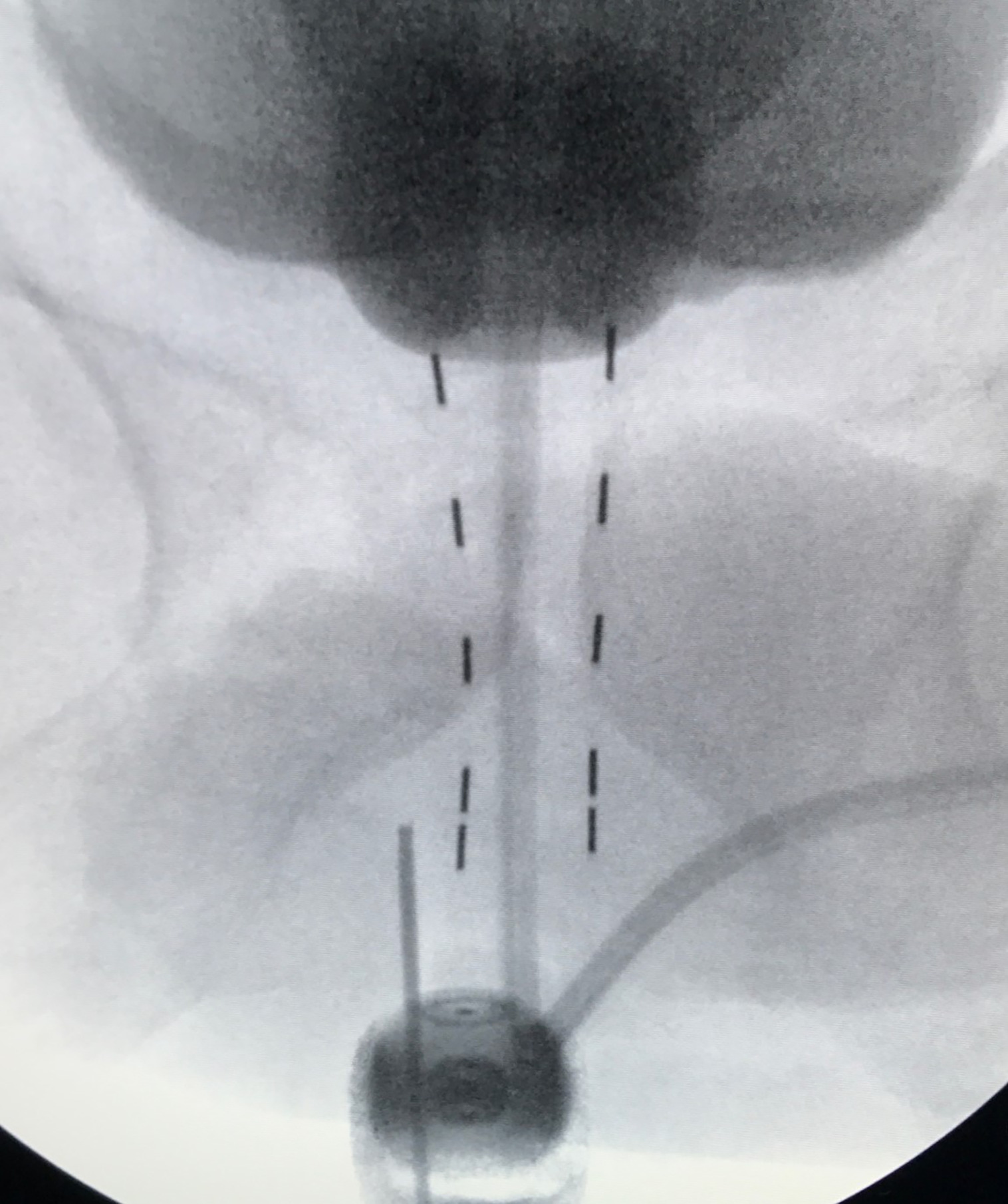 Needle tip marking the bottom of the prostate apex.