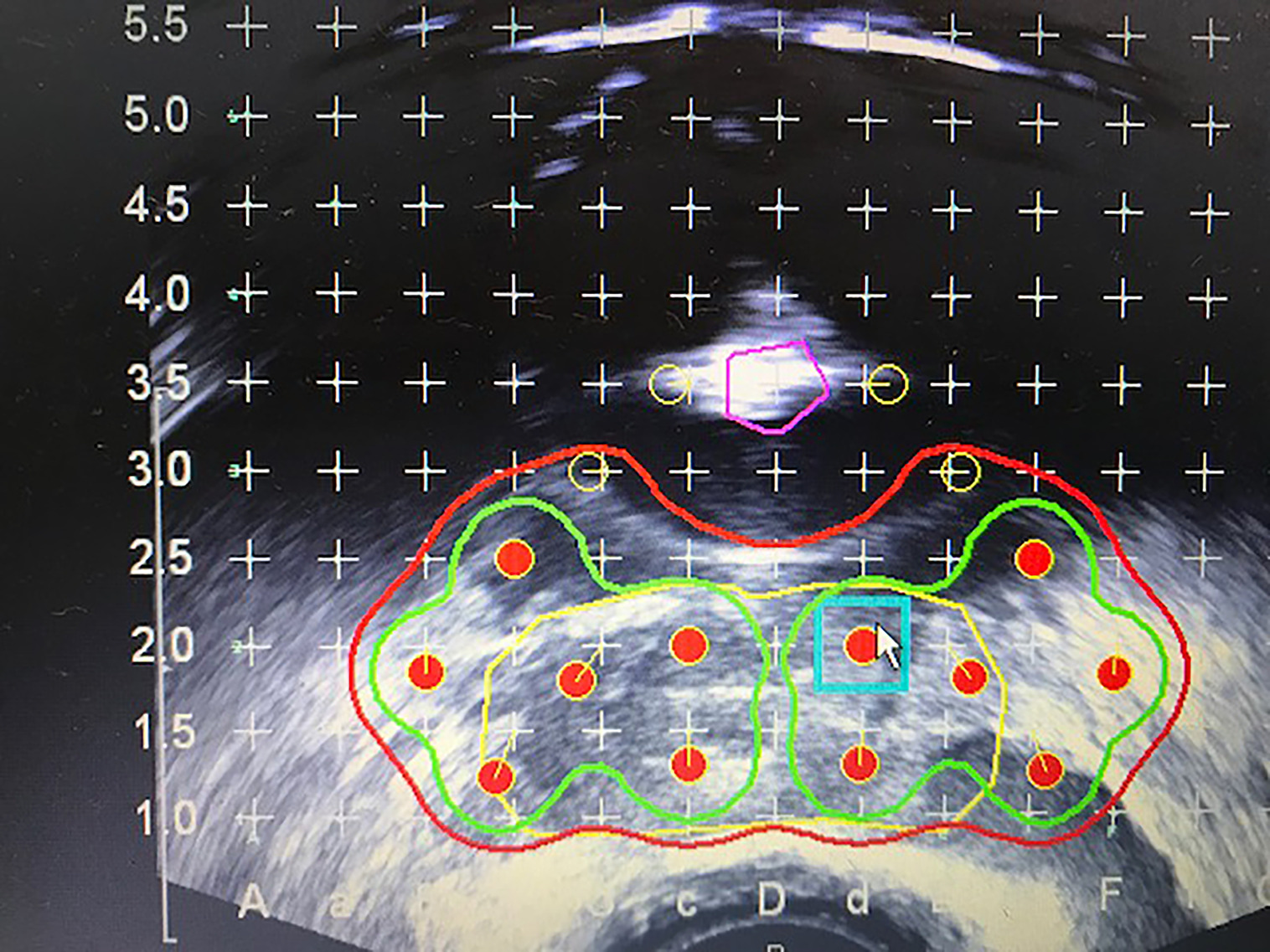 Additional loose seeds placed posterior to the catheter balloon in rows 2 and 2.5 to fill in isodose at the central prostate base. Red = 100% (14,400 cGy), green = 150% (21,600 cGy), and yellow = proximal seminal vesicle clinical target volume.