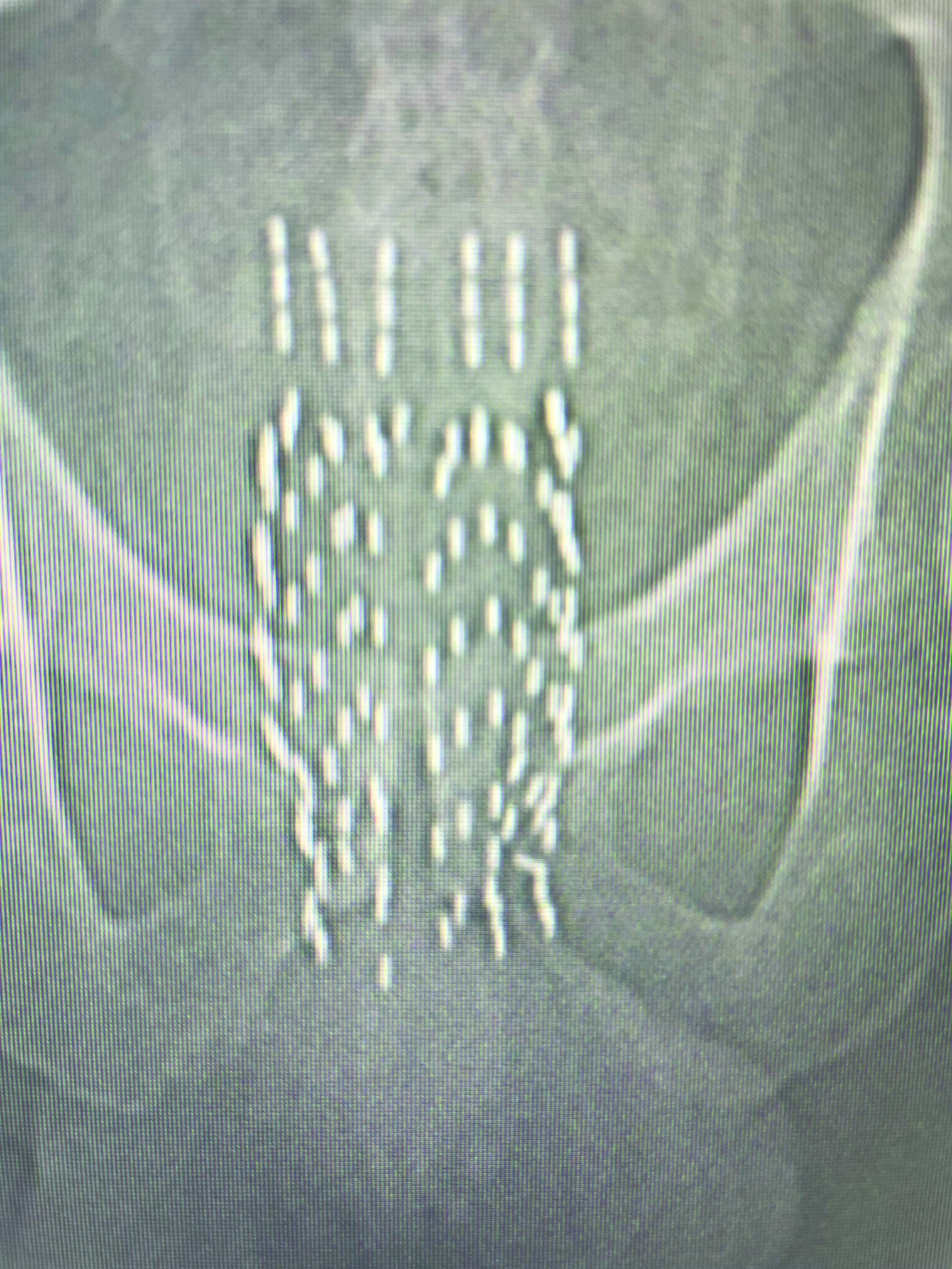 Prostate fluoroscopy image with seminal vesicles implanted.