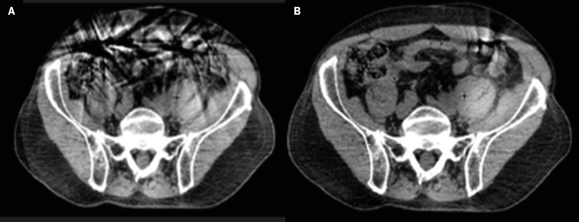 Impact of breath-hold on cone-beam CT (CBCT) quality. (A) Nonbreath-hold CBCT demonstrating significant artifact. (B) Breath-hold CBCT with resultant reduction in artifact.