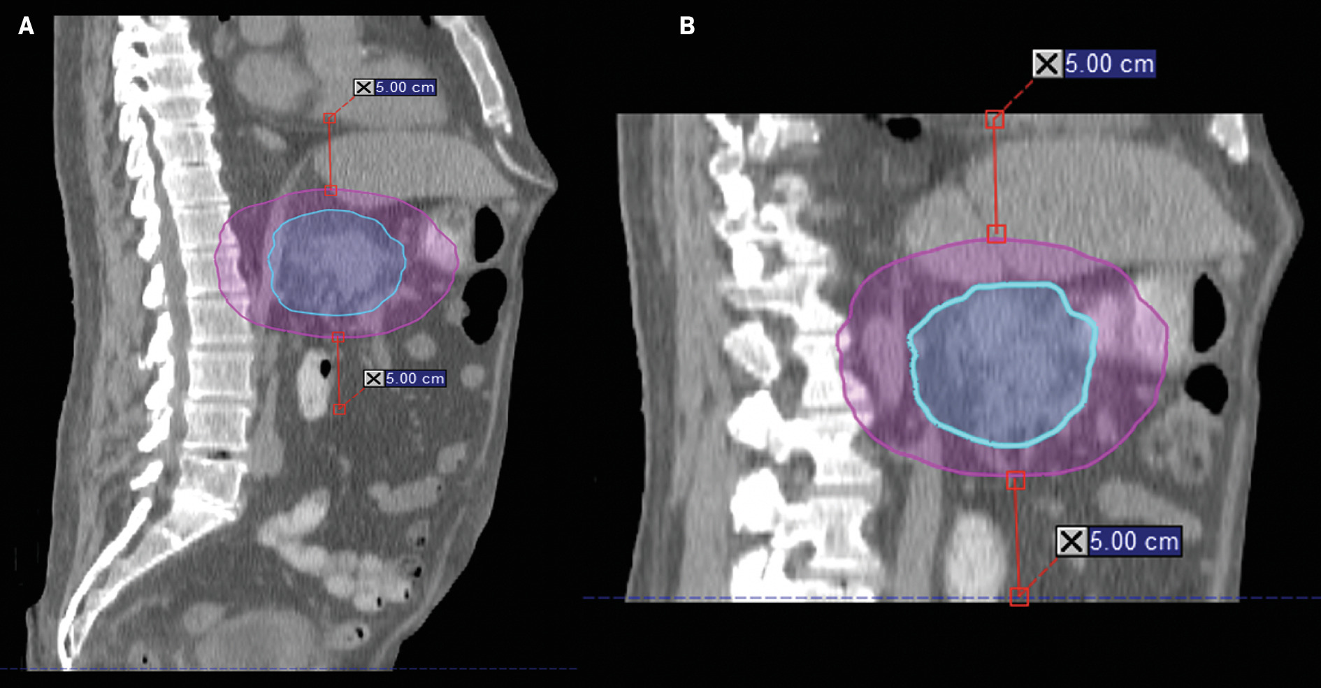 Example of shortened scan for treatment planning. (A) Sagittal view of full-length scan and (B) shortened-scan length. Using a shortened scan for treatment planning minimizes optimization time and patient time on the table.