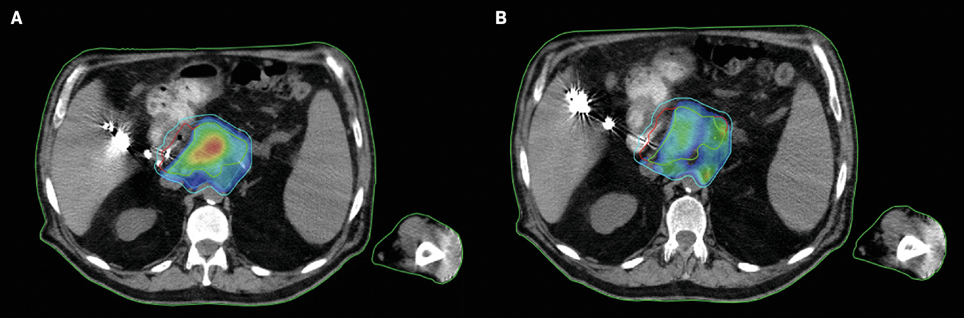 Pancreas CT-guided adaptive radiation therapy plan dose distribution. (A) Shown here is the pancreas plan dose distribution when the template includes goals for structures such as GTV_OPT, which are designed to contain the hotspot within the gross tumor volume (GTV) compared with (B) the pancreas plan dose distribution without any GTV_OPT goals. The hotspots exist more peripherally, which may be of concern when treating near organs at risk.