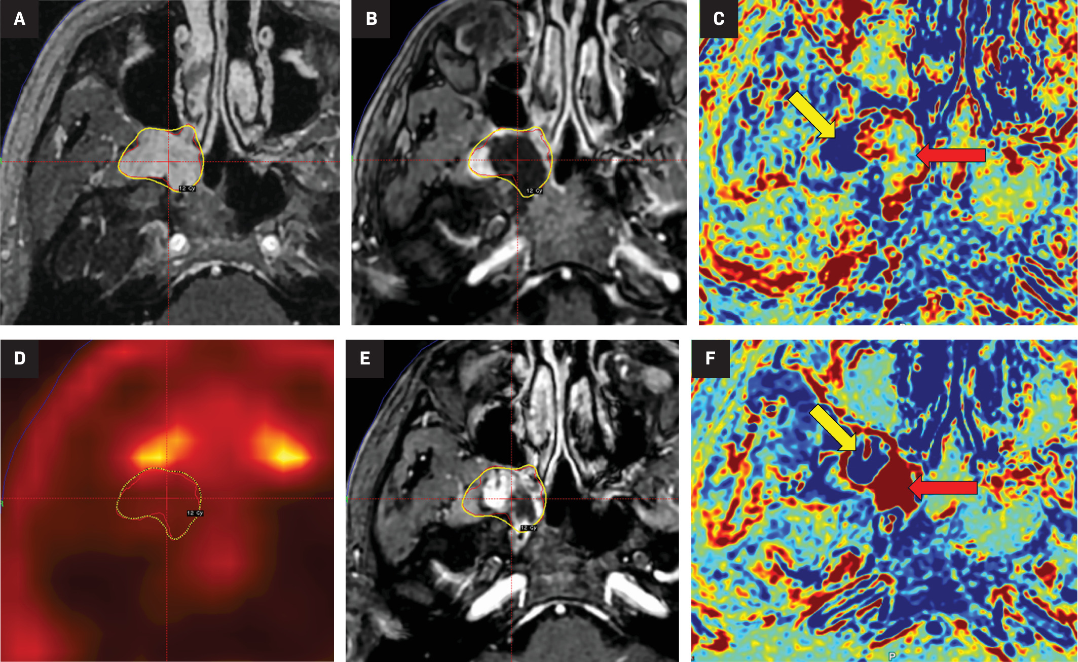 (A) MRI of the day of the gamma knife radiosurgery (GKRS) treatment showing the extracranial segment of the trigeminal schwannoma, with the yellow line showing the 12 Gy marginal dose at the 61% isodose line (IDL). (B) MRI within 6 h from the GKRS treatment showing tumor necrosis (center of the cursor). (C) MRI contrast-clearance analysis, with the yellow arrow showing the area in blue that corresponds to the viable tumor and the red arrow showing the area of necrosis. (D) PET scan, 1 month after, with lower 18 fluorodeoxyglucose uptake at the extracranial segment of the tumor. (E) 3-month follow-up MRI with collapse of the tumor. (F) 3-month follow-up MRI contrast-clearance analysis, with the yellow arrow showing the area in blue that corresponds to the viable tumor and the red arrow showing the area in red that corresponds to tumor necrosis.