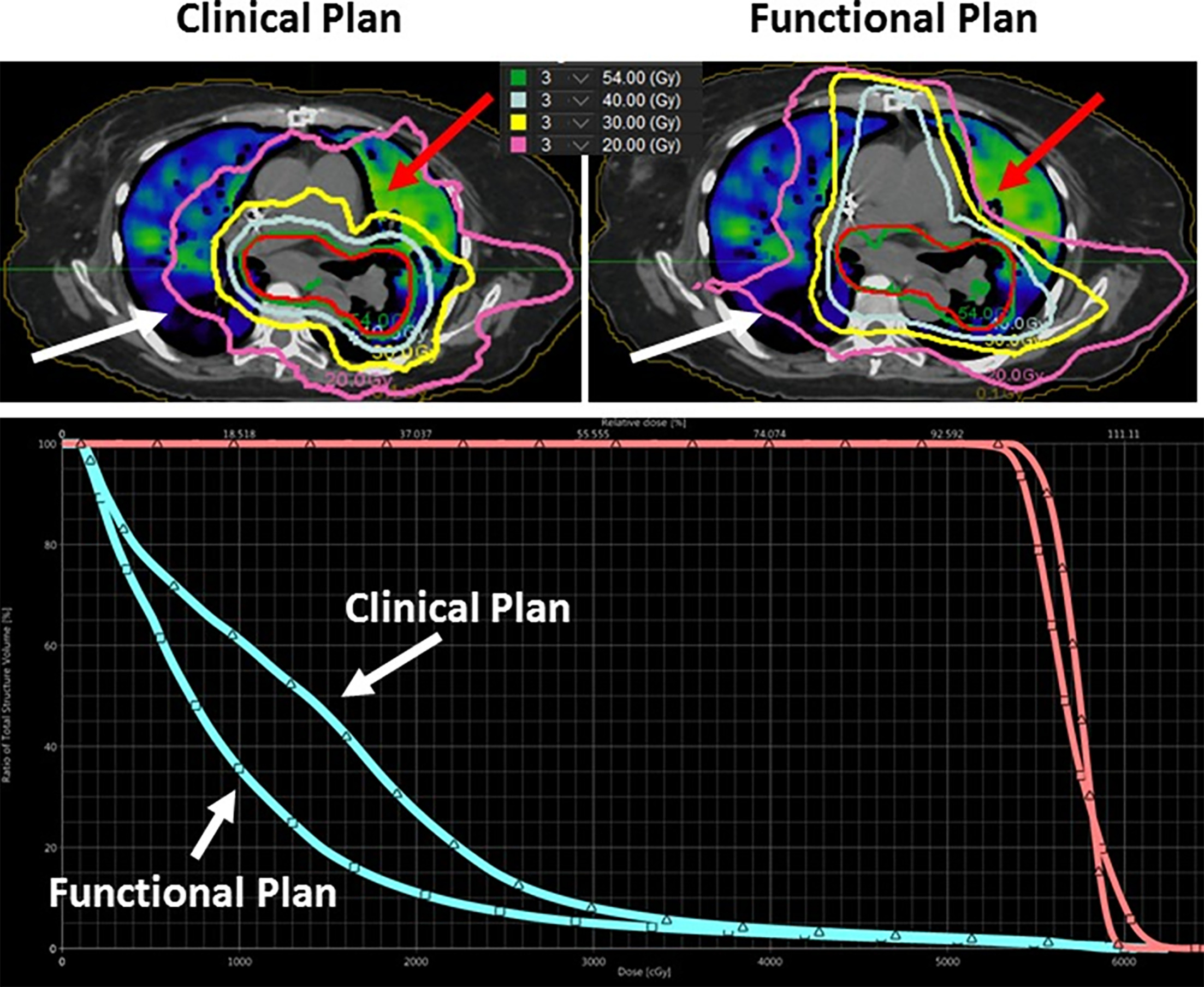 Representative comparison of a standard clinical plan and a four-dimensional CT (4DCT) ventilation-guided functional avoidance plan. The figure shows the planning CT, 4DCT ventilation overlay, isodose distributions, planning target volume, and dose-volume comparison for the functional lung contour and target. The functional plan demonstrates selective reduction of dose to better-ventilated lung while maintaining target coverage and standard planning constraints, with dose redistributed preferentially toward lower-functioning lung when clinically acceptable. Adapted/reproduced from Waxweiler et al.24