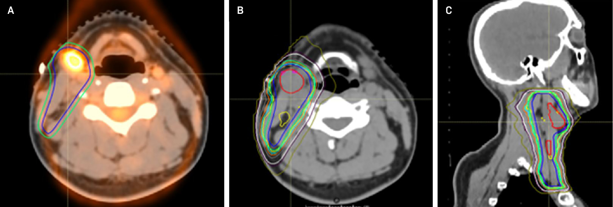 Treatment planning images illustrating the pretreatment PET/CT demonstrating the extent of disease (A), with corresponding axial (B) and sagittal (C) views of the involved-site radiation therapy plan.