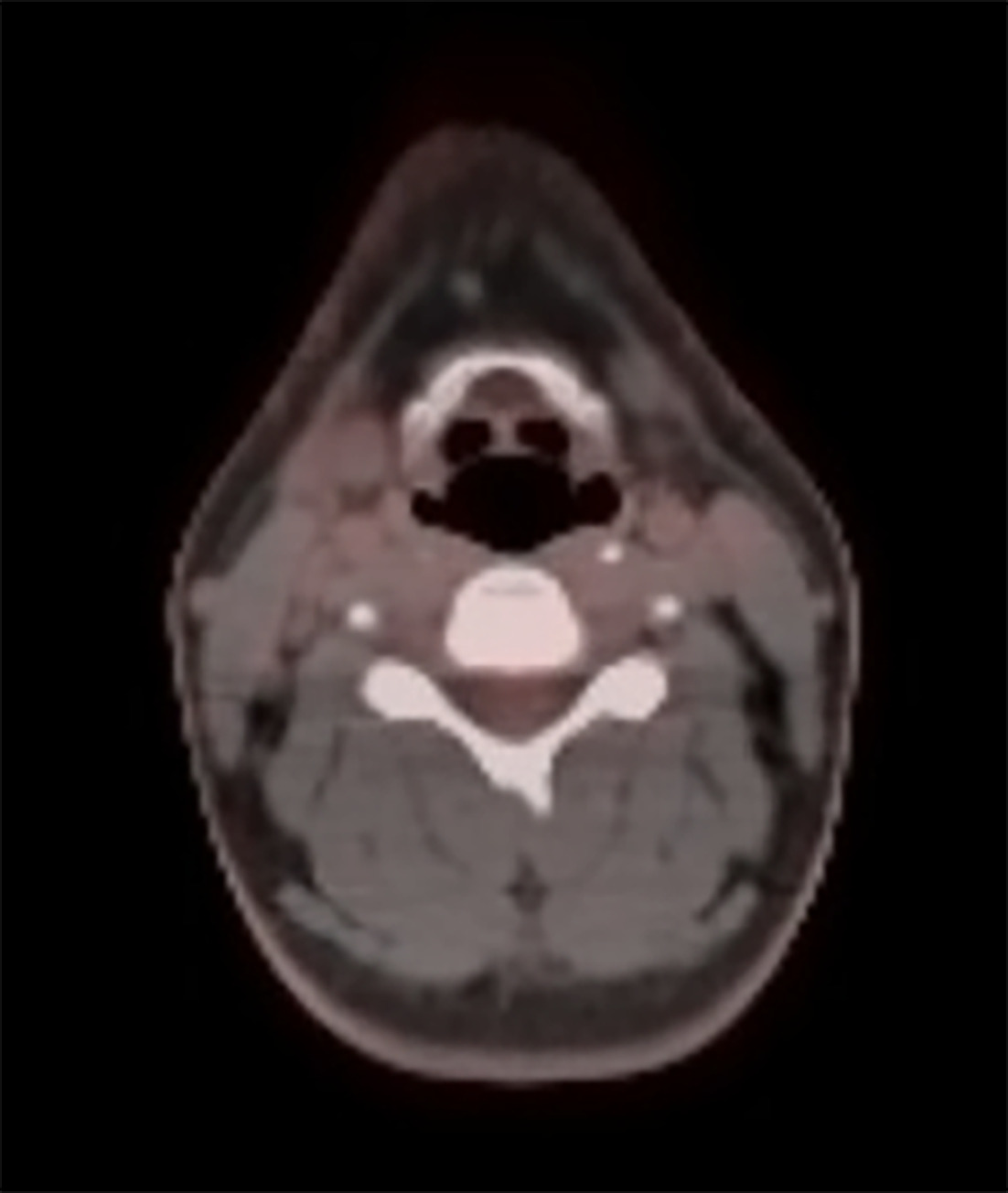 PET/CT 3 months following treatment demonstrating complete response.