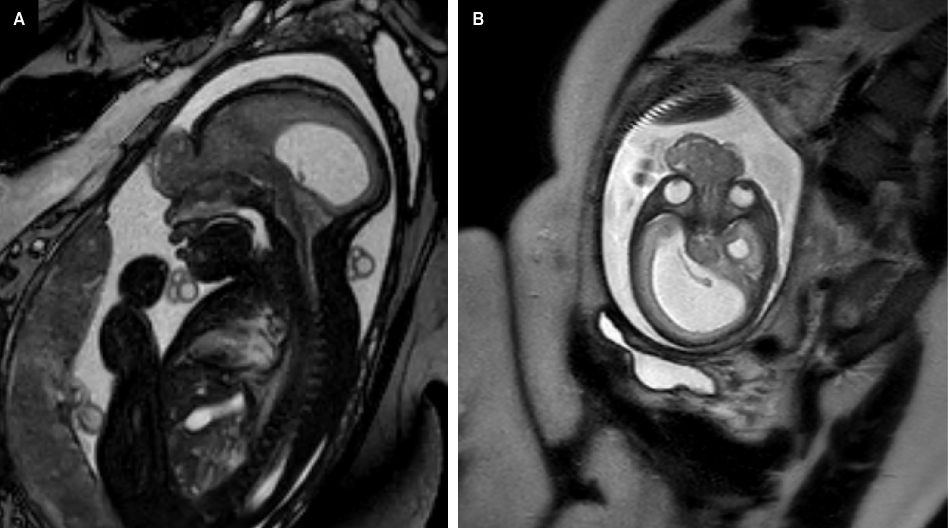 (A) Sagittal and (B) axial T2-weighted fetal MRI images showing an anterior midline defect in the frontoethmoidal region at the level of the orbits extending from the nasal bone superiorly to the frontal area. There is a well-defined external sac containing dysmorphic brain tissue with a small volume of cerebrospinal fluid. There is asymmetric enlargement of the right lateral ventricle.