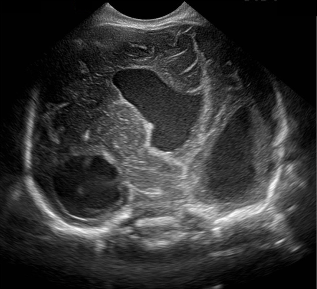Coronal head US images performed on the day of birth showing an enlarged, distorted right lateral ventricle. Because the left frontal lobe is herniated into the encephalocele (not visible on the US), the right hemisphere appears larger, and there is leftward midline shift.