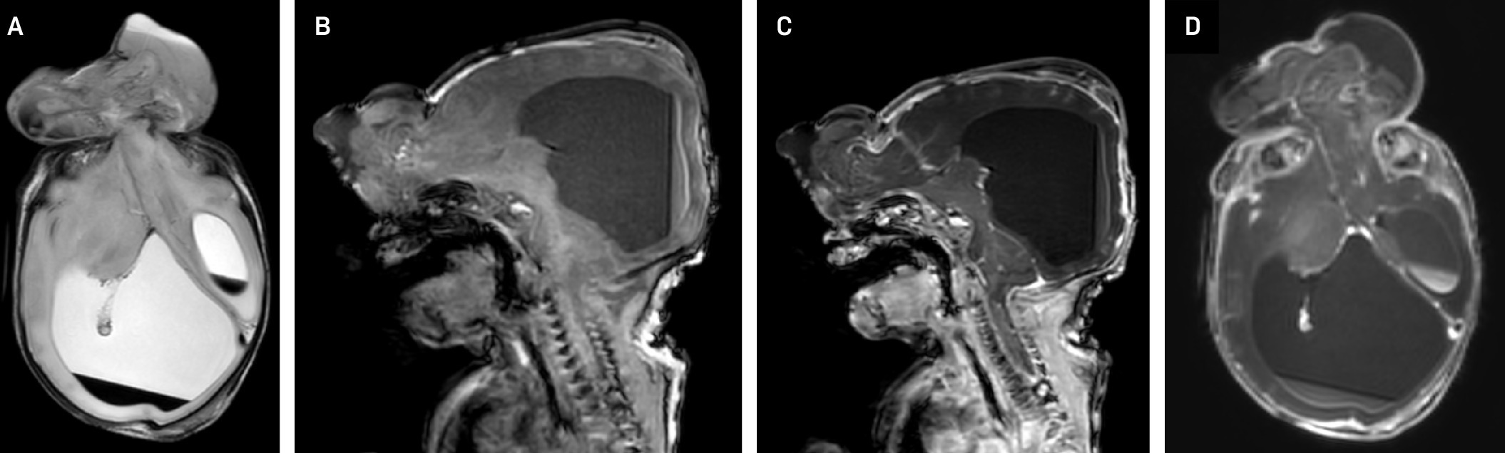 (A) Axial T2 and (B) sagittal T1 MRI performed at 1-day of life showing a large frontoethmoidal encephalocele with brain parenchyma, meninges, and CSF herniating through a midline defect at the level of orbits. (C) Axial and (D) sagittal T1 post contrast MRI shows the anterior aspect of the superior sagittal sinus and other venous structures extending into the encephalocele. The herniated brain parenchyma includes more of the left cerebral hemisphere and appears grossly dysplastic. There is resultant distortion of the brain parenchyma, leftward deviation of midline, and asymmetric enlargement of the right lateral ventricle. Blood/CSF levels are seen in both lateral ventricles.