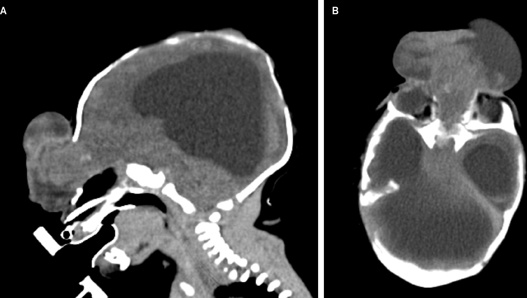 (A) Axial and (B) sagittal CT performed at 6 days of life showing the anterior midline defect and the large frontoethmoidal encephalocele and lateral ventriculomegaly with layering hemorrhage.