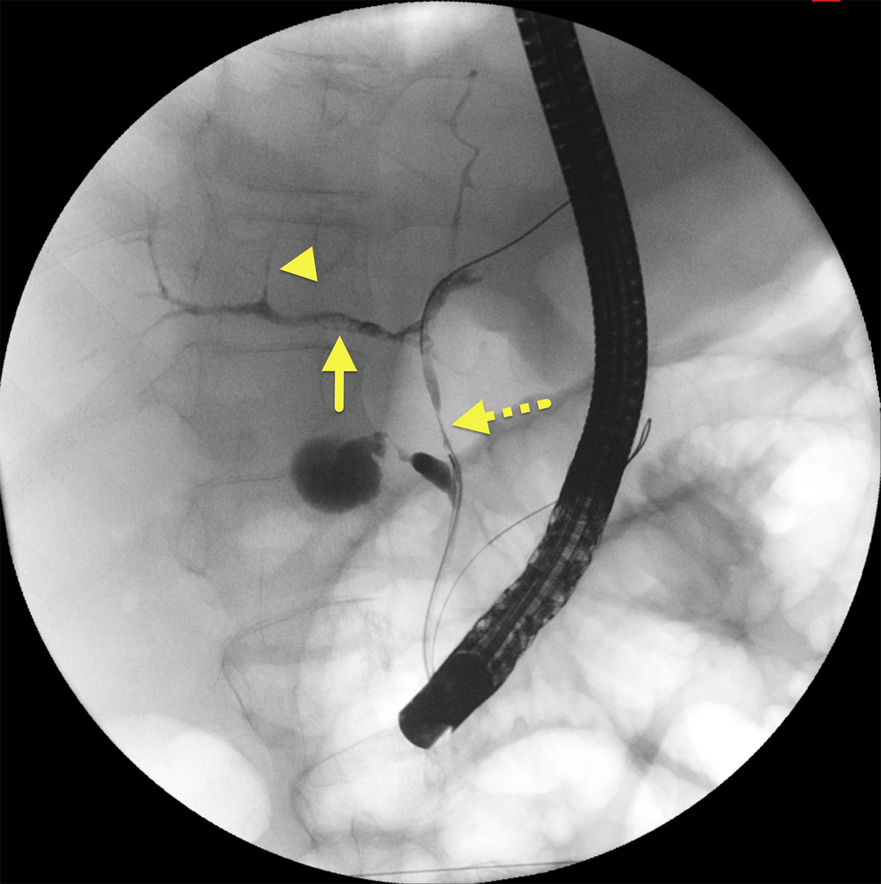 Endoscopic retrograde cholangiopancreatography image showing narrowing (dashed arrow) of the distal common bile duct, debris (arrow) within the right hepatic duct, and pruning (arrowhead) of intrahepatic ducts typical of advanced primary sclerosing cholangitis.