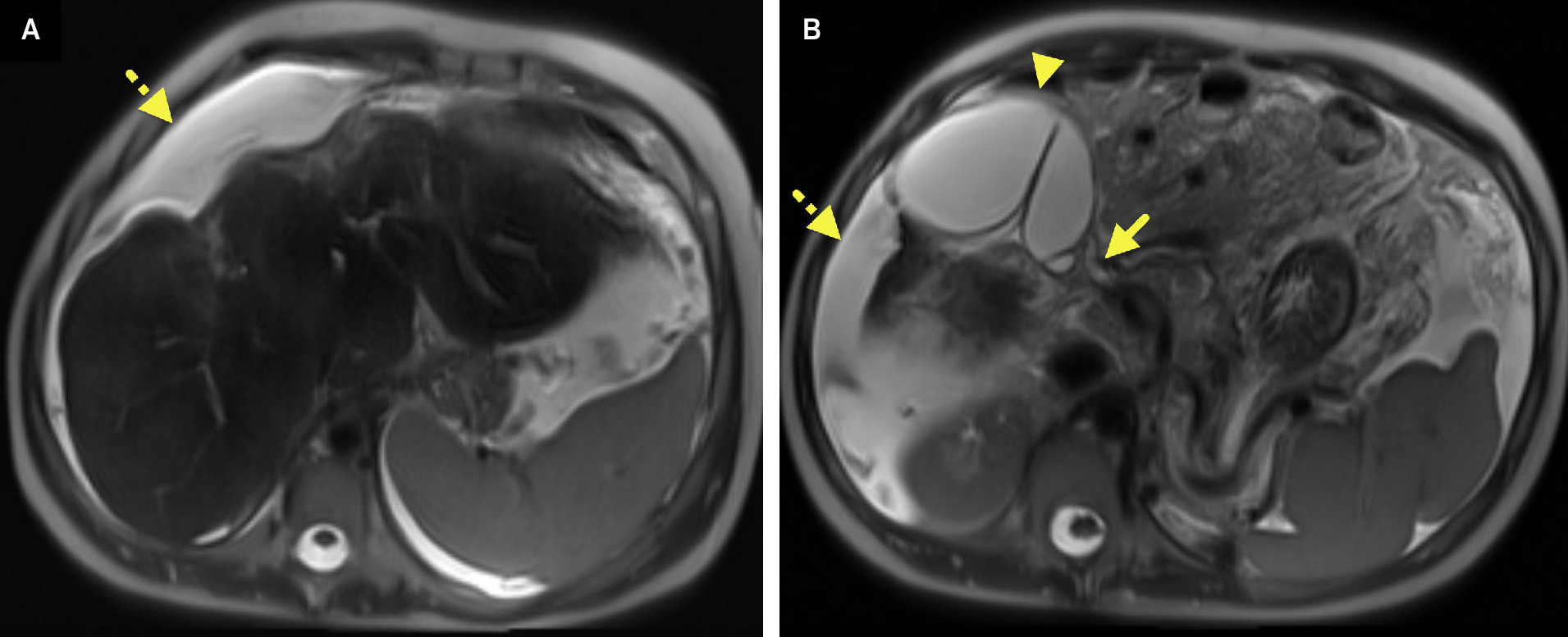 MR cholangiopancreatography image at the level of the (A) liver and (B) gallbladder showing the liver to have an undulating macronodular contour with wispy increased T2 signal. There is a large volume of ascites (dashed arrow). The gallbladder (arrowhead) is distended, and the common bile duct (arrow) is relatively enlarged. Note that intrahepatic bile ducts are not visible.