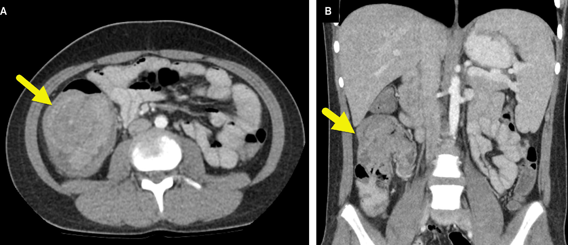(A) Axial and (B) coronal CT images showing a large soft-tissue mass (arrow) within the ascending colon. The mass causes a colo-colonic intussusception.