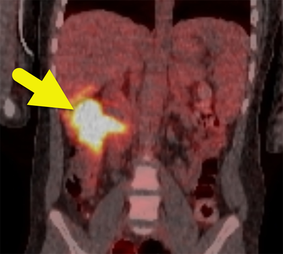 Coronal image from fused F18 fluorodeoxyglucose PET/CT showing intense uptake within the colonic mass (arrow). The mass had a maximum standardized uptake value of 18.2. There was no metastatic uptake.