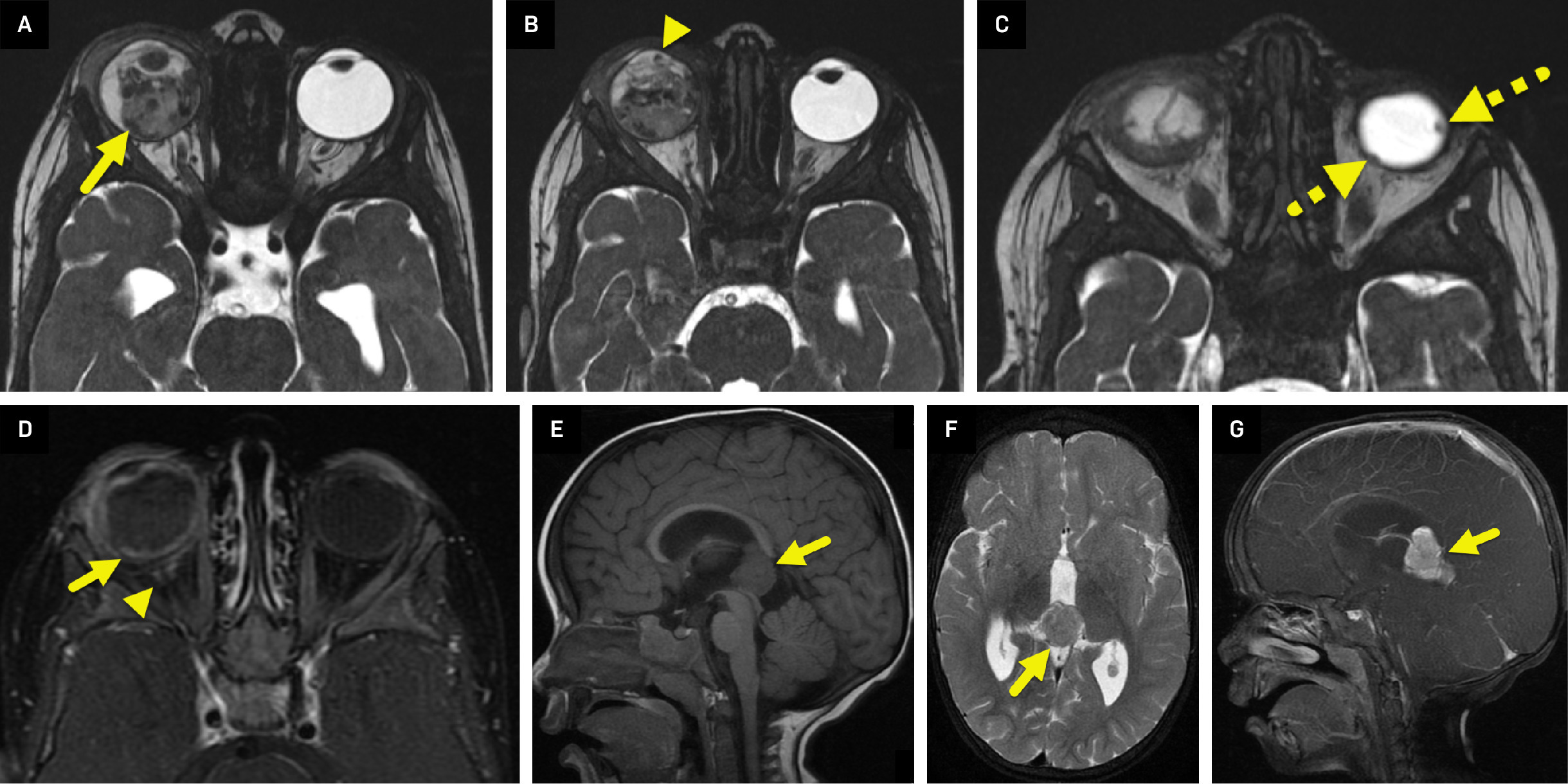 MRI performed in an 8-month-old male infant with leukocoria. (A-C) Axial three-dimensional fast imaging employing steady-state acquisition showing a large heterogeneous lobulated lesion (arrow) within the right globe. Nodules extend to the anterior chamber (arrowhead). 2 small lesions are present in the left globe (dashed arrows). (D) Axial T1-weighted postcontrast sequence with fat saturation showing mild enhancement of the retina (arrow) and optic nerve (arrowhead) near its insertion at the optic disk. (E) Sagittal T1-weighted image at midline showing the hypointense pineal mass (arrow). (F) Axial T2-weighted image showing the mass (arrow) to be slightly hyperintense to the adjacent thalamus. The lateral ventricles are enlarged. (G) Sagittal T1-weighted postcontrast image at midline showing diffuse enhancement of the pineal mass (arrow).