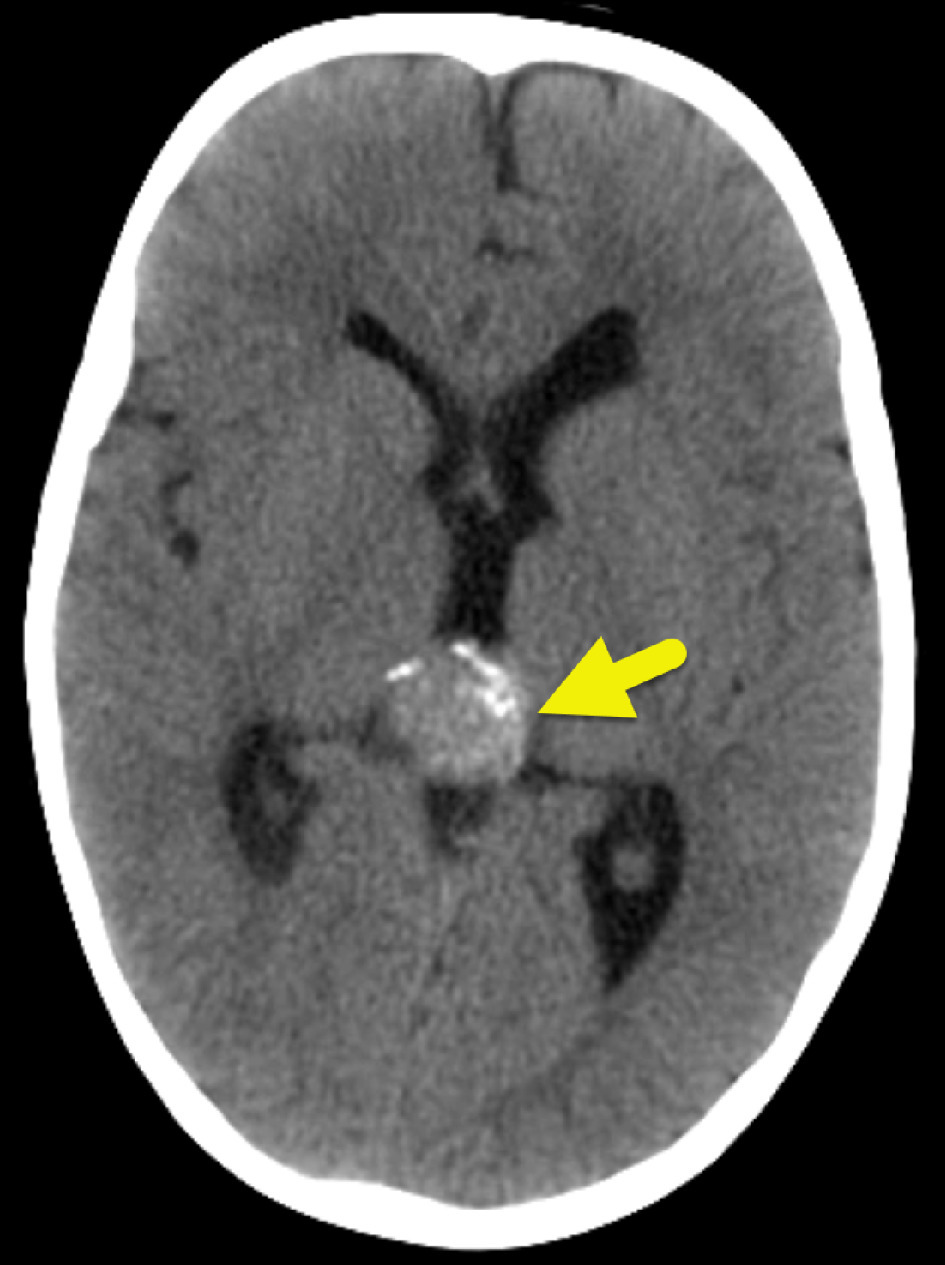 Axial CT of the head showing the pineal mass (arrow) with peripheral calcification. The lateral and 3rd ventricles are enlarged.
