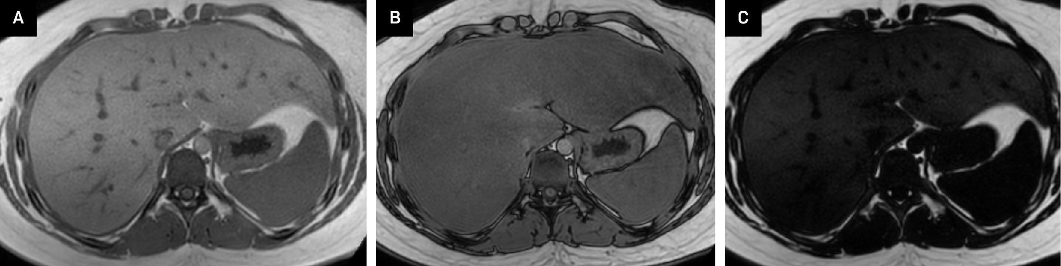 Axial multiphase Dixon MRI of the liver showing (A) in-phase, (B) opposed-phase, and (C) fat-only (water-saturated) images. There is marked signal dropout on the opposed-phase image, consistent with hepatic steatosis. The fat-only image shows mild parenchymal signal, confirming excess hepatic fat. The hepatic fat fraction was measured at 21%.