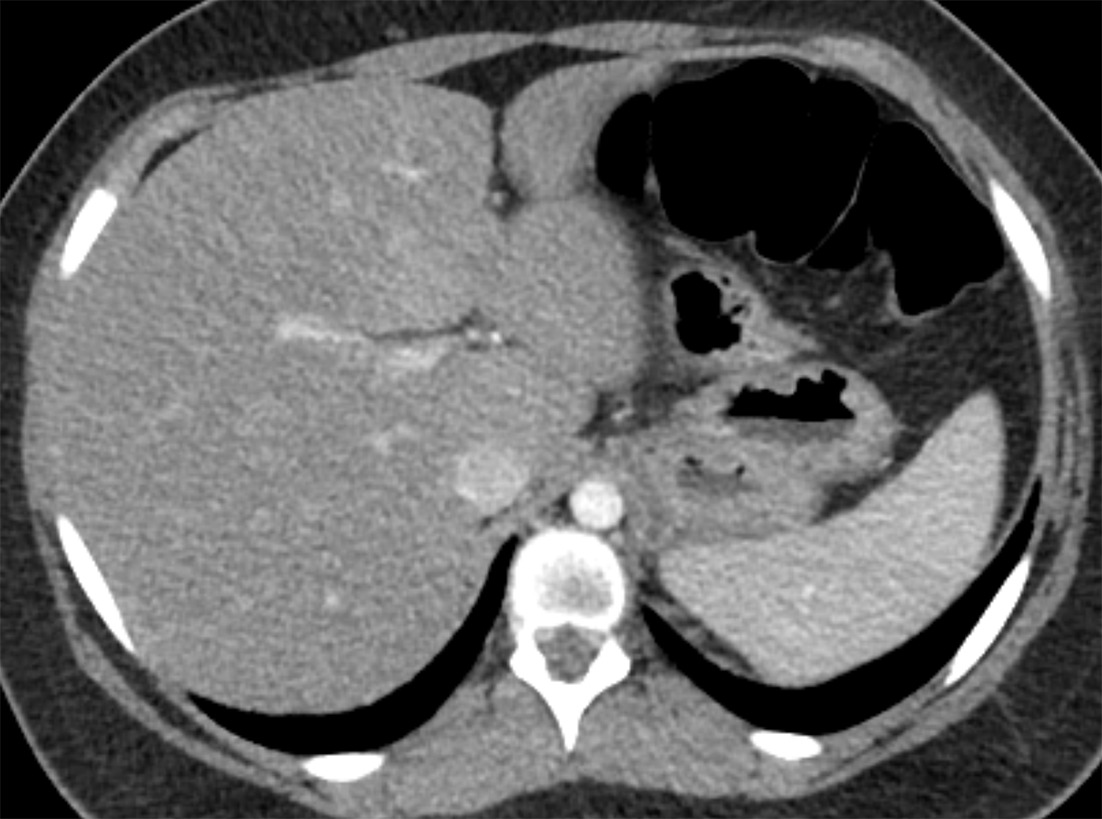 Axial CT image of the liver demonstrates diffusely decreased attenuation of the liver relative to the spleen. Average Hounsfield unit measurements were 66 for the liver and 119 for the spleen.