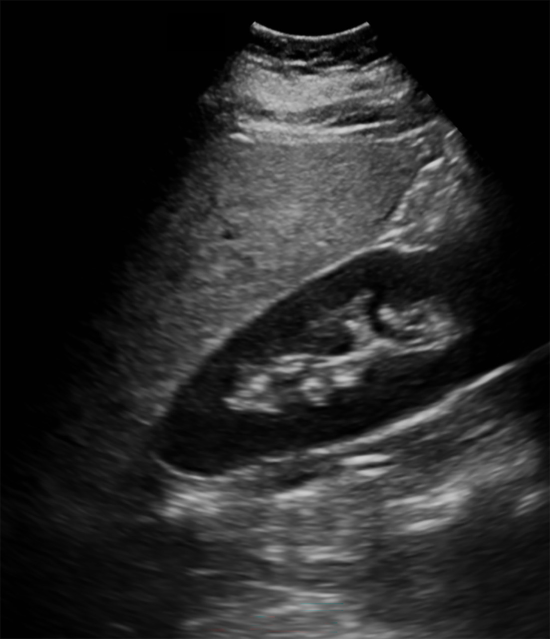 Longitudinal US image of the right kidney showing increased echogenicity of the liver relative to the renal cortex, consistent with hepatic steatosis.