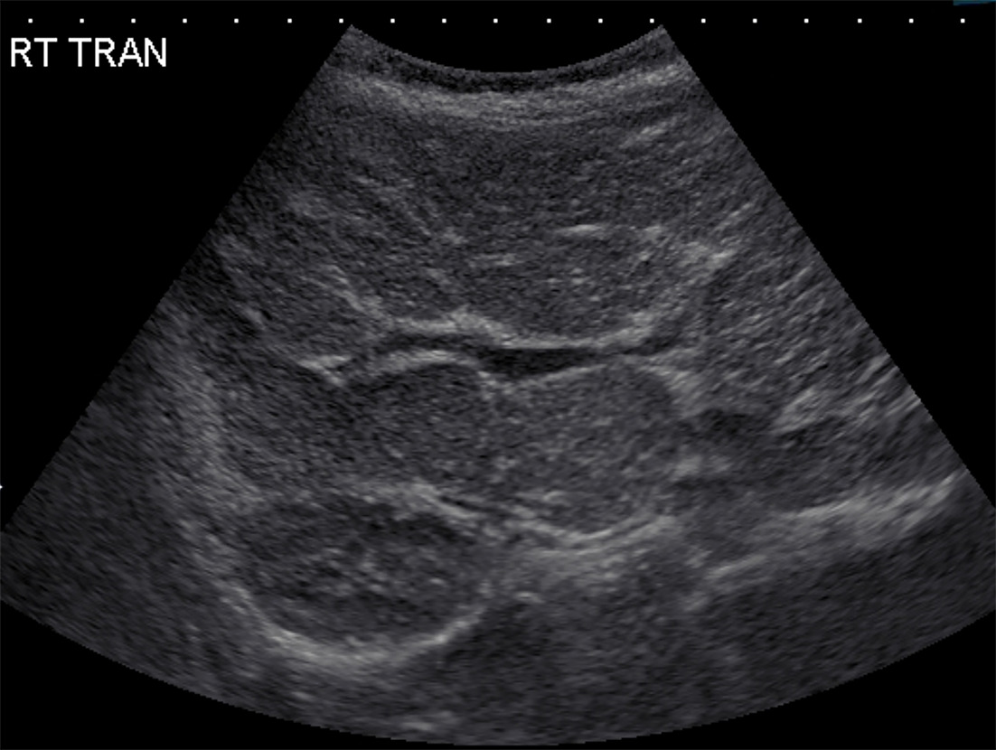 Transverse US of the liver showing the liver to have a heterogeneous parenchyma with a nodular contour. Fine hyperechoic bands of fibrosis intersperse the nodules.