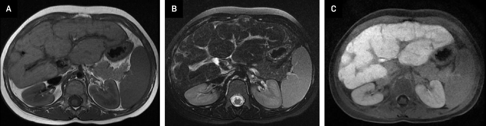 (A) Axial T1-weighted, (B) T2-weighted, and (C) T1-weighted obtained during the hepatobiliary phase of contrast administration showing the liver to be small and have a nodular contour. Bands of fibrosis intersperse the nodular contour.