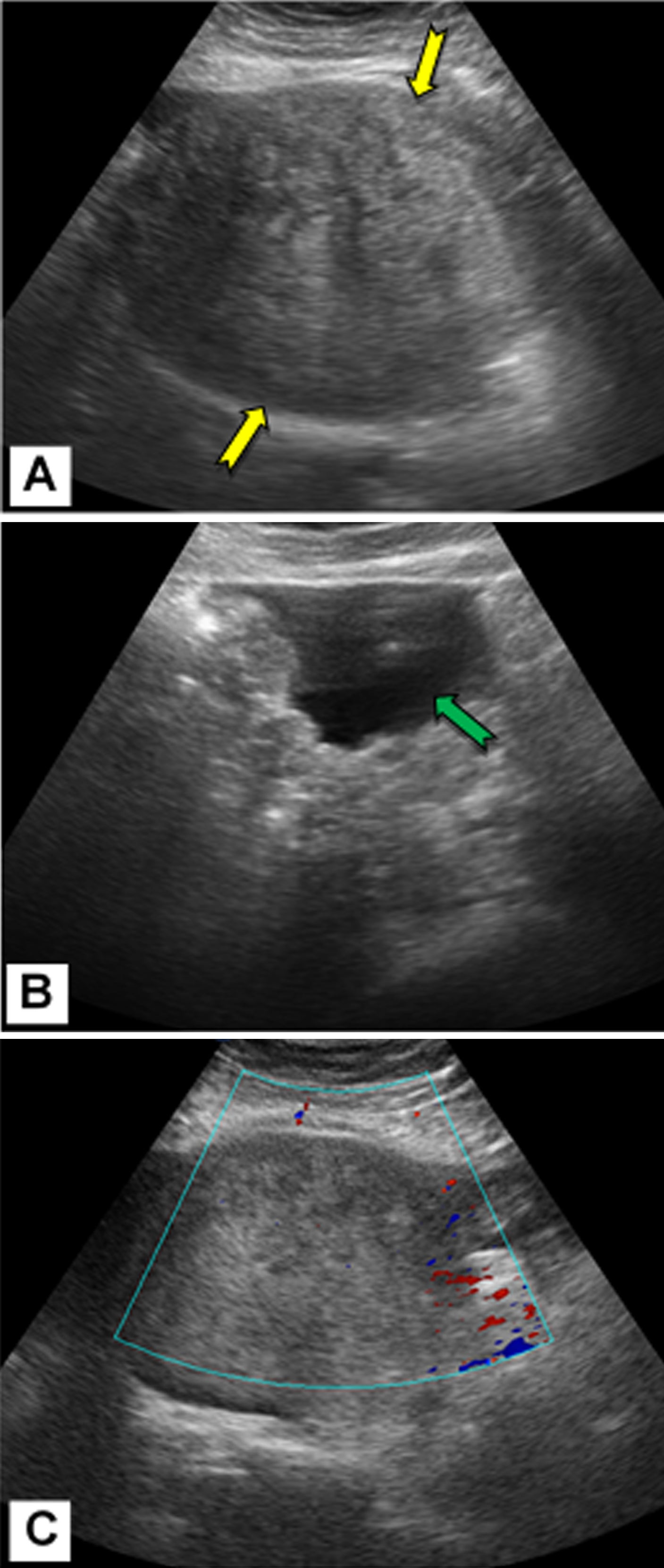 GI-RADS: A valuable tool to improve ultrasound reporting of adnexal masses