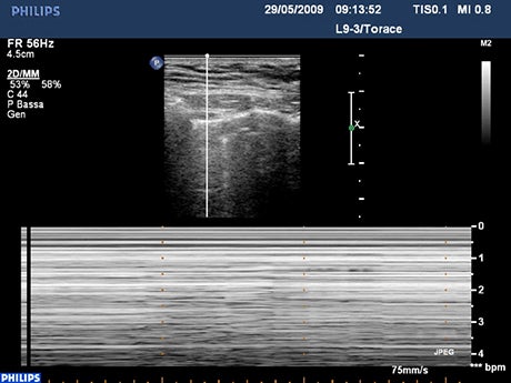 CA-FAST Ultrasound: An alternative to chest CT as initial exam for trauma patients