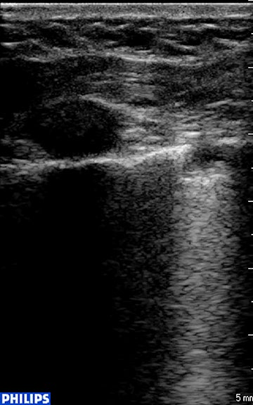 CA-FAST Ultrasound: An alternative to chest CT as initial exam for trauma patients