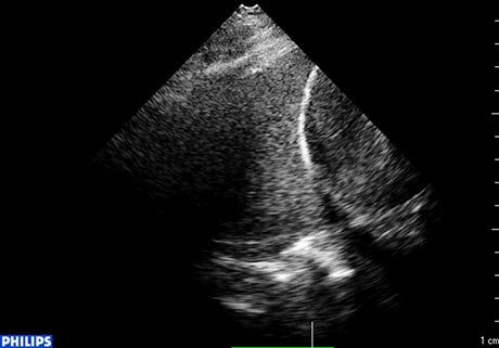 CA-FAST Ultrasound: An alternative to chest CT as initial exam for trauma patients