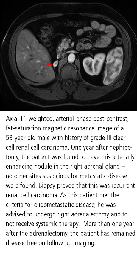 Radiologists can play pivotal role for patients with oligometastatic disease