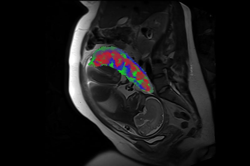 Novel MRI Method Provides View of Placenta During Pregnancy
