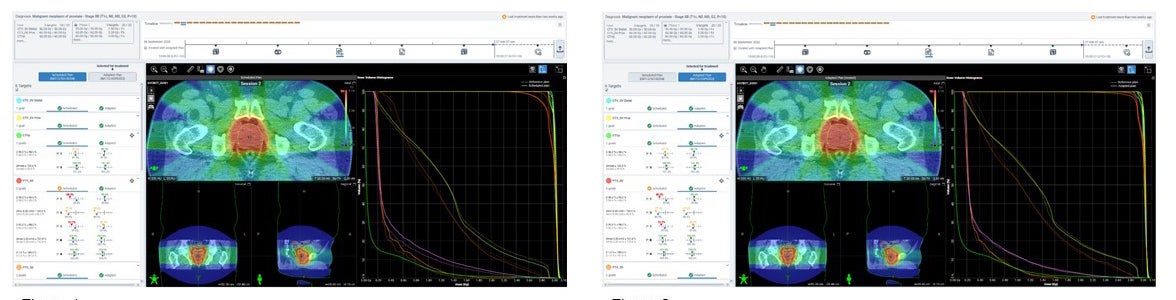 Artificial Intelligence in Radiation Therapy: Adaptive Applications and Beyond