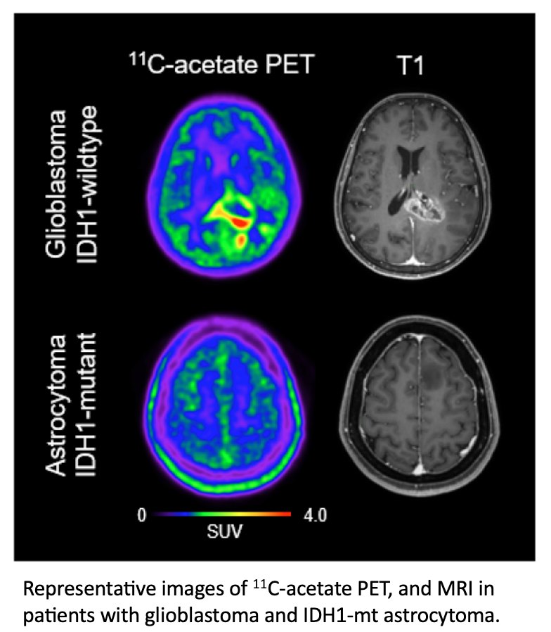 PET Imaging Technique Depicts Glioblastoma Tumor Microenvironment
