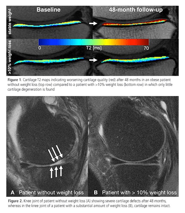 RSNA 2015: MRI confirms that weight loss helps protect knee cartilage