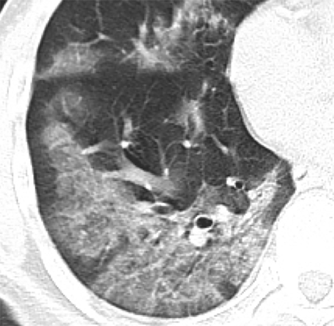 Long-term Lung Injury Found in 72% of Hospitalized COVID-19 Patients