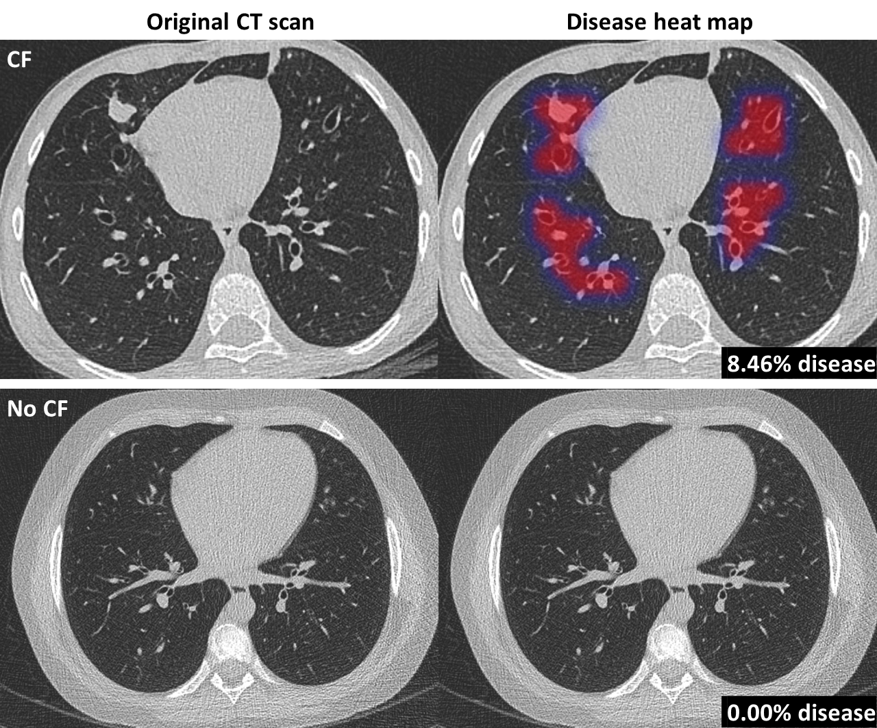 AI Solution Automates Analysis of CT Scans in Cystic Fibrosis Patients