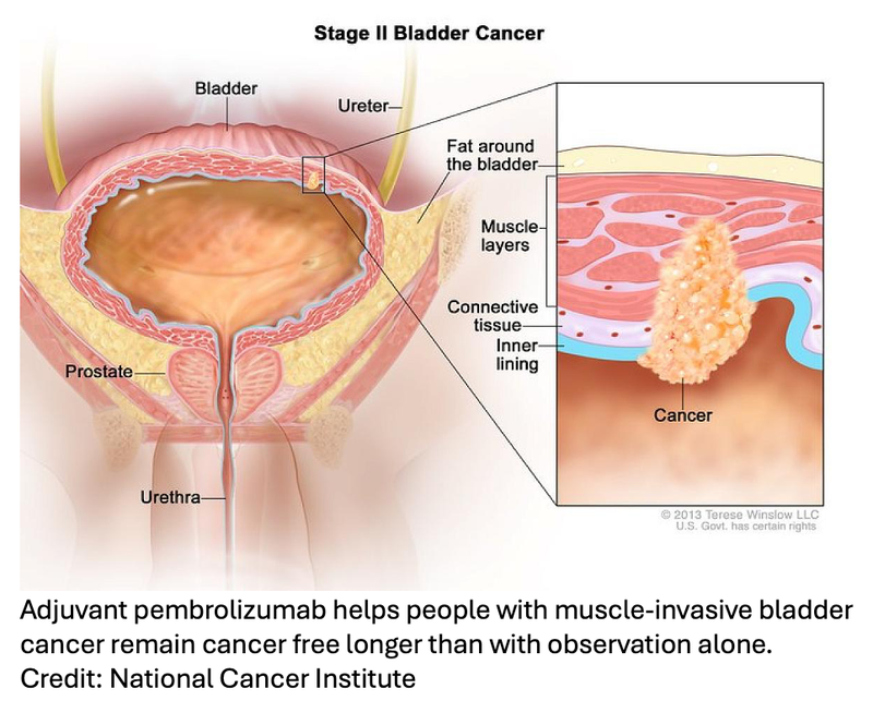 Immunotherapy After Surgery Helps High-Risk Bladder Cancer Patients Live Cancer Free Longer