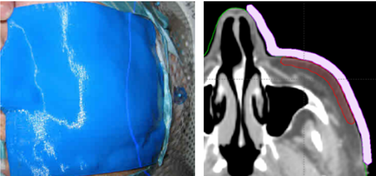 Added Dimensions: 3-D Printing Applications in Radiation Oncology