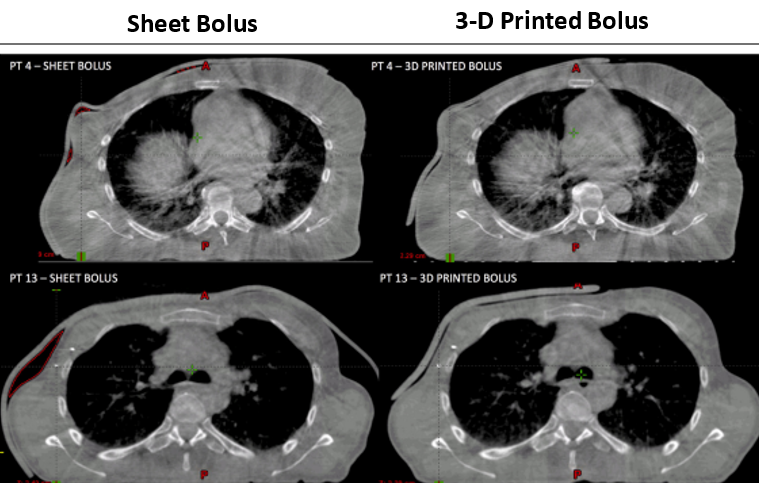 Added Dimensions: 3-D Printing Applications in Radiation Oncology