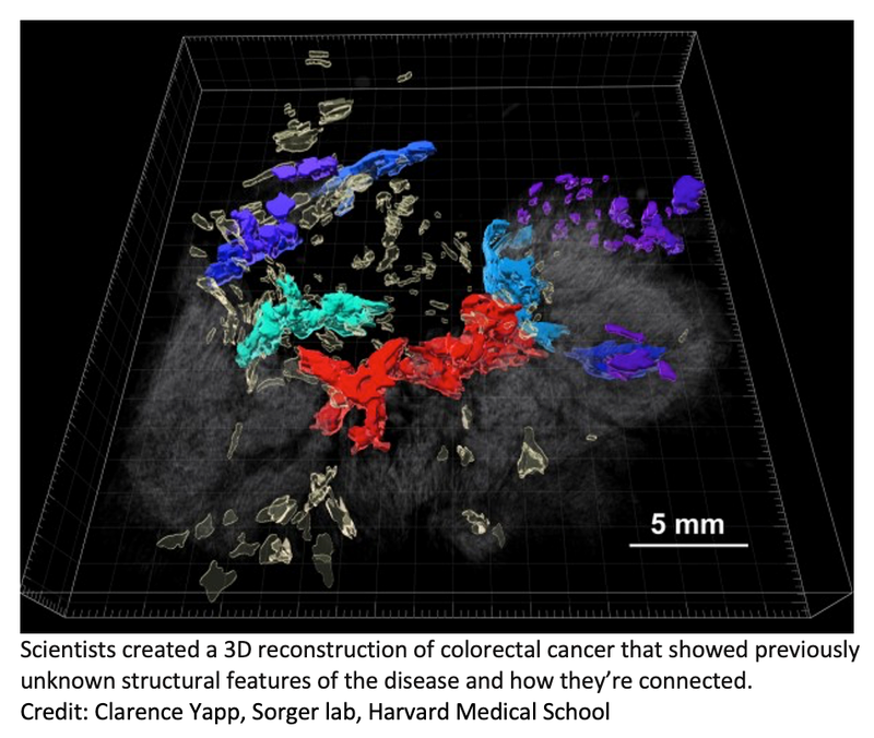 2D and 3D Maps Provide New Insight Into Colorectal Cancer