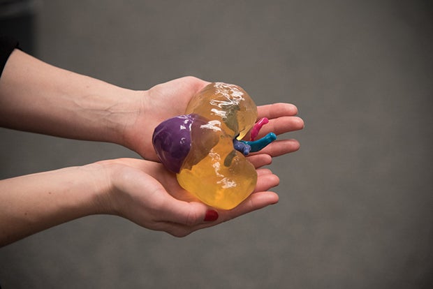 3D MRI-derived models aid surgical planning for complex kidney cancer surgery