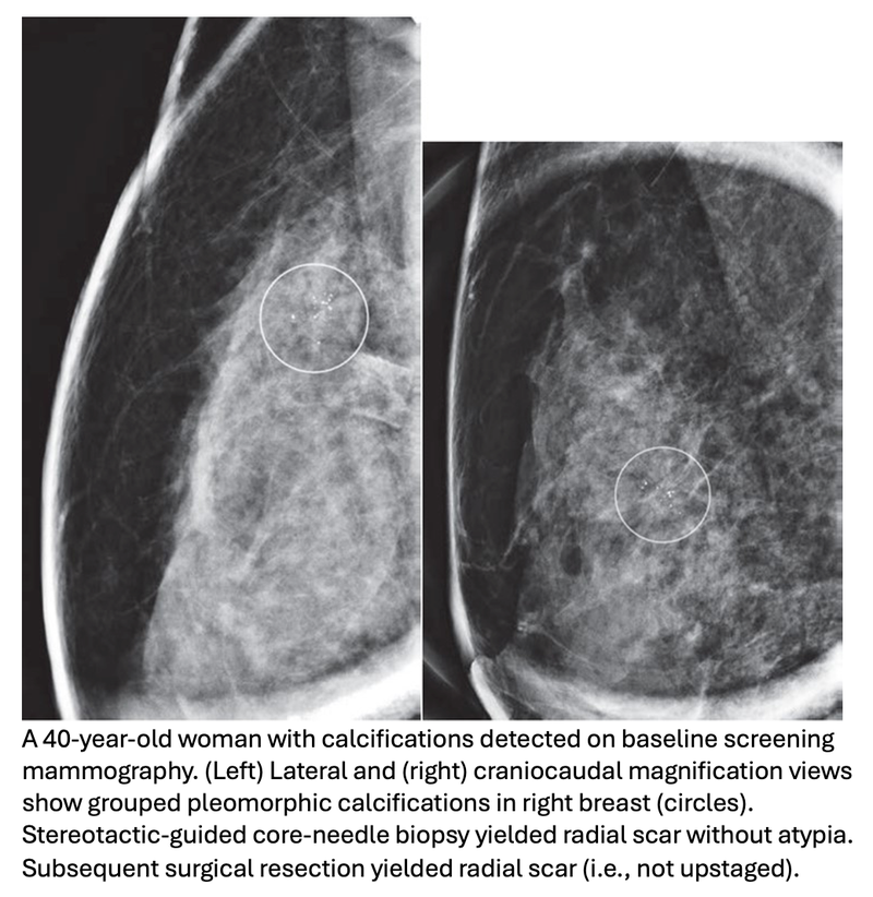 Imaging Surveillance, Not Surgery, Is Reasonable for Breast Radial Scars Without Atypia