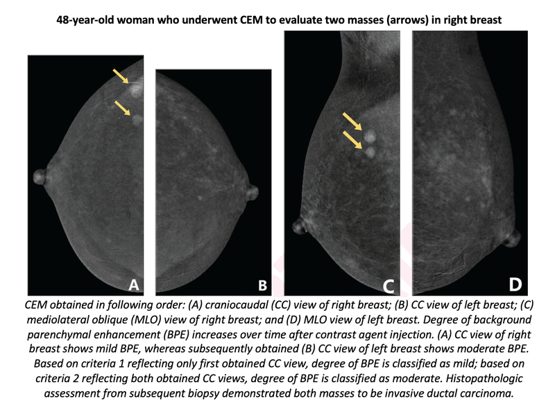 Clinical Factors Impact Early BPE Contrast-Enhanced Mammography
