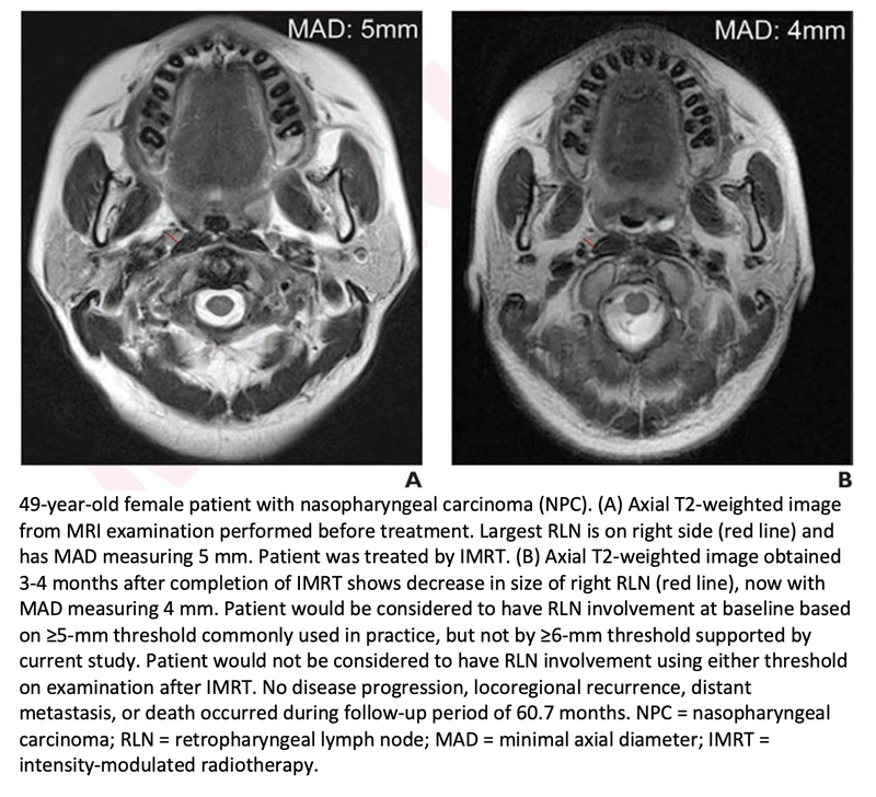 In Nasopharyngeal Carcinoma, Larger Lymph Node Threshold Optimizes Outcomes