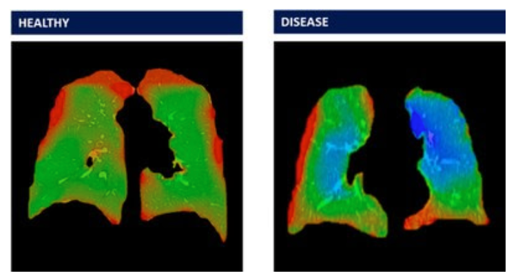 Vanderbilt Evaluates 4D Lung Software in Pilot Study of Military Veterans
