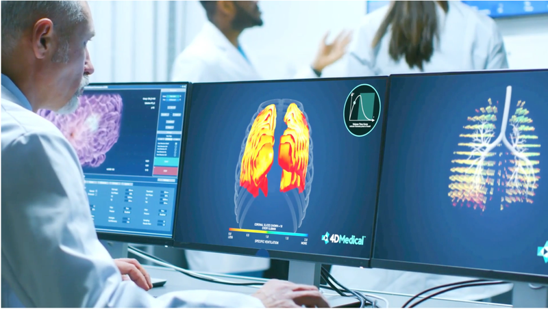 Providence St. Joseph Uses 4D Lung Imagery for Animated View of Lung Function