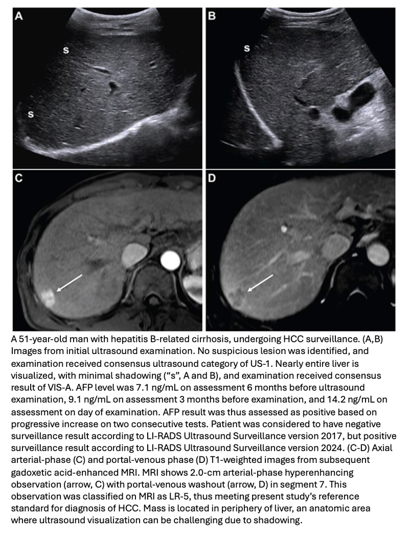 New ACR LI-RADS Ultrasound Version Increases Sensitivity for HCC