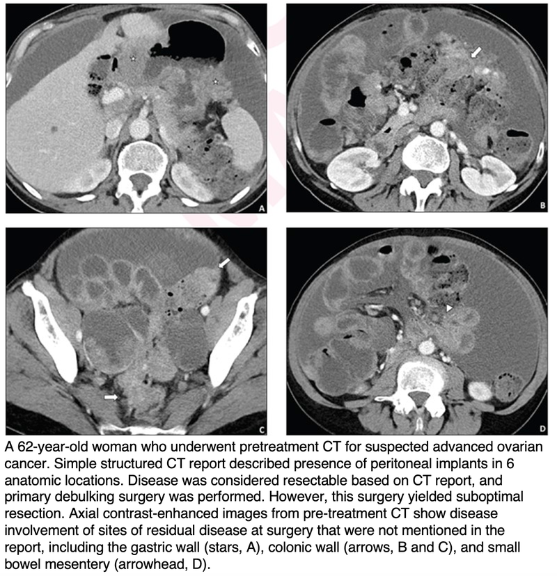 Synoptic Reports Improve Pretreatment CT in Advanced Ovarian Cancer Patients